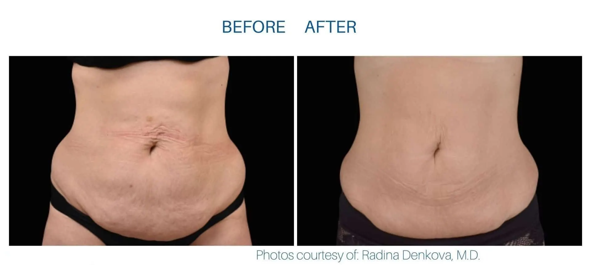 Emsculpt Neo effect on abdomen